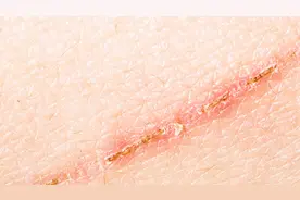 伤口掉痂后的红印，是疤痕吗？专家给你标准答案视频封面