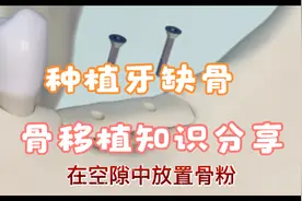 骨移植过程！自己的骨头取下来固定到缺骨部分修复好就可以种牙啦视频封面