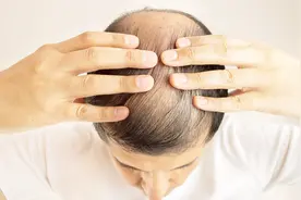 米诺地尔搽剂真会长头发吗？别担心，这可是脱发一线外用治疗药！