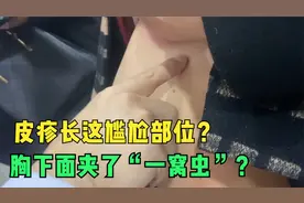 皮疹长这尴尬部位？胸下面夹了“一窝虫”？医生科普反向银屑病