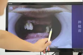 种植牙案例：60多岁男性只剩几颗牙还松动，医生全部拔除做种植牙视频封面