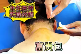 病案分享：富贵包形成原因解析，头夹肌劳损导致，针刀实操松解视频封面