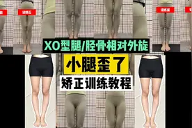 【XO型腿】矫正教程！小腿歪了？胫骨相对股骨外旋！