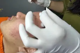 针挑黑头视频封面