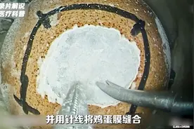 你敢看吗？天坛医院张亚卓，脑肿瘤微创手术全记录 。