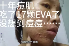 十年痘肌！吃了17颗EVA……没想到痘痘……视频封面