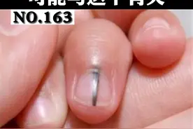 指甲上出现一根黑线，担心身体出问题，其实大多不用太在意！#指甲 #健康科普 视频封面