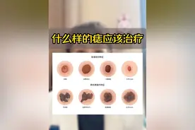 什么样的痣应该治疗#痣和黑色素瘤有什么区别 #色素痣 #什么是黑色素瘤 #什么样的痣需要警惕 #张恒远得的黑色素瘤是什么病视频封面