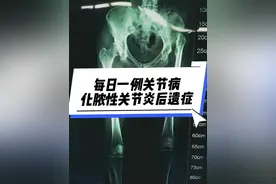 每日一例关节病：化脓性关节炎后遗症。#髋关节 #关节置换视频封面