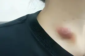 身上这4个部位长“疙瘩”，很可能是癌转移！特别是满足这2点！图片