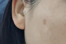 激光祛斑记录图片