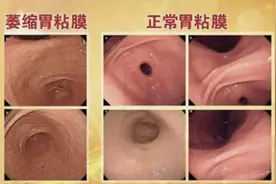 我用几颗乌梅，治好了萎缩性胃炎，就是寒热错杂，搞清证型就行了图片