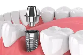 刚刚种完牙，分享一下感受，和预想的还真不一样图片