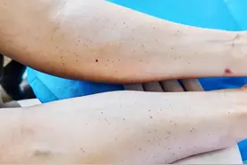 女子手臂上都是小红点，会癌变吗？医生提醒→图片