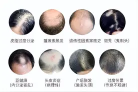 男性型脱发的特征与发展过程：男性脱发的症状和进展阶段解析图片