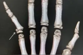 课间扎堆玩“挤暖暖” 9岁男孩被挤断手指图片