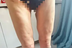 做吸脂手术半年后，女子双腿凹凸不平！图片