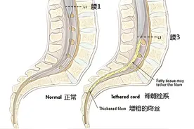 脊髓栓系综合征图片