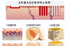 痘留下的痘坑、痘印，如何拯救？教你一招，直接制服！图片