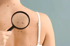 点痣只需2块钱？51岁阿姨网购后“破相”，专家：购物要谨慎图片