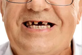 植得关注丨半口牙缺失如何种植修复？图片