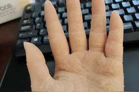 手脚皮肤易发干，变厚、干裂？这是掌跖角化症，我来告诉你如何治疗图片