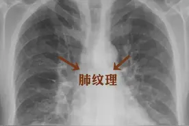 “肺纹理增多”，是一种什么病？会不会很严重？医生详细解答图片