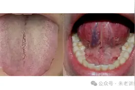 舌下青筋粗，舌面苔白有裂纹，千万别直接化瘀，关键在健脾养胃图片