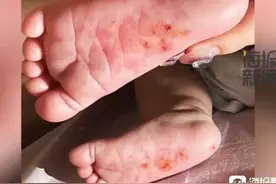 骇人听闻！育婴师在婴儿呛奶后猛拍婴儿后脑并用剪刀扎脚！图片