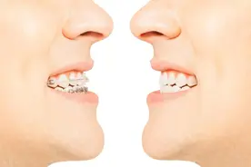 牙齿正畸别盲目！这些后遗症和危害，你一定要清楚！图片