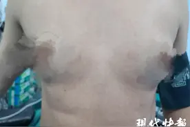 39岁男子胸部不断变大，医生：系双侧乳腺发育，建议手术图片