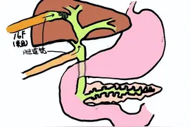 肝内胆管结石图片