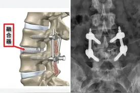 我的腰间盘突出治疗经验和教训（之四：开放手术经历）图片