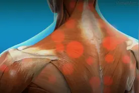 筋膜炎的常见症状和治疗方法图片