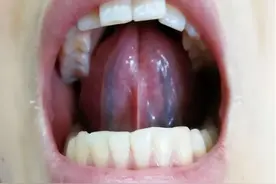 舌下青筋黑紫就要活血？ 错！ 舌面白腻 祛痰化瘀 舌面淡 补血化瘀图片