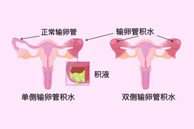 输卵管积水是备孕“拦路虎”？这样内外兼治，轻松扫清自怀障碍！图片