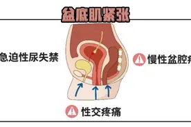 会阴神经痛：医生告诉你"难言之痛"从何而来图片