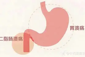 胃溃疡和十二指肠溃疡有什么区别？该怎么治疗？一文说说清楚图片