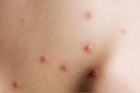 皮肤上的小疙瘩究竟是什么？可能是HPV作祟？医生教你正确应对图片