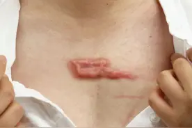 三招坚持下来，帮你解决疤痕问题！有多年疤痕的朋友别错过！图片