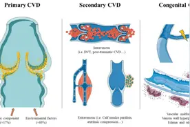 你的双腿为何“不堪重负”？揭秘下肢静脉瓣膜关闭不全的五大元凶图片