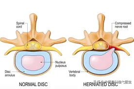 腰间盘突出压迫神经腿疼腿麻怎么办？图片