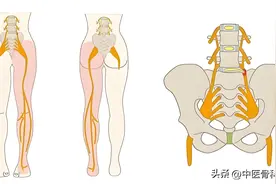 腰4～5及腰5骶1腰椎间盘突出症是什么？图片