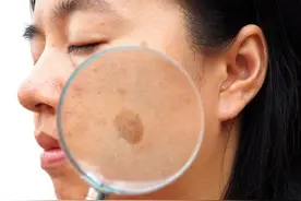 激光治疗咖啡斑效果如何？没有结痂就不算有效吗？科学揭示真相图片