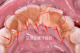太震撼了！我竟然在家刷掉了堆积如山的牙结石！只靠这1个方法！图片