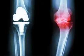 人工关节置换效果如何？能像正常人一样走路跑步吗？图片