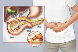 胰腺有癌，吃饭先知？吃饭时出现4个怪象，可能是胰腺癌警惕图片