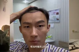 我第一次植发的经历：6000块钱植了700个毛囊图片