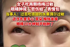 女子#吃两颗杨梅过敏眼睛肿成悲伤蛙  当事人：吃完眼睛10分钟就开始肿了，已经四五年没过敏了。视频封面