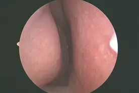 看看鼻子里面是啥样
#医学科普 #健康科普 #科普 #医学知识科普视频封面